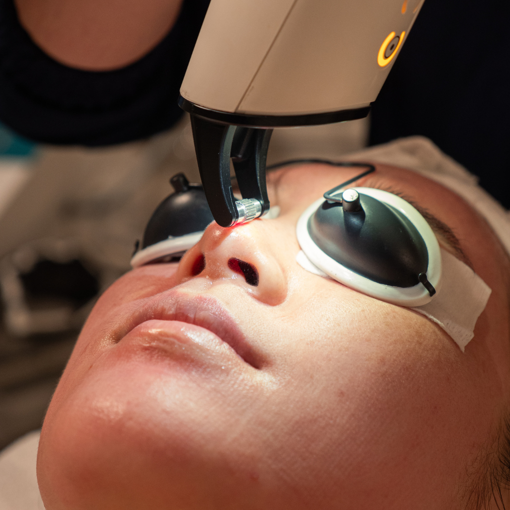 Candela Frax Laser Skin Resurfacing Treatment