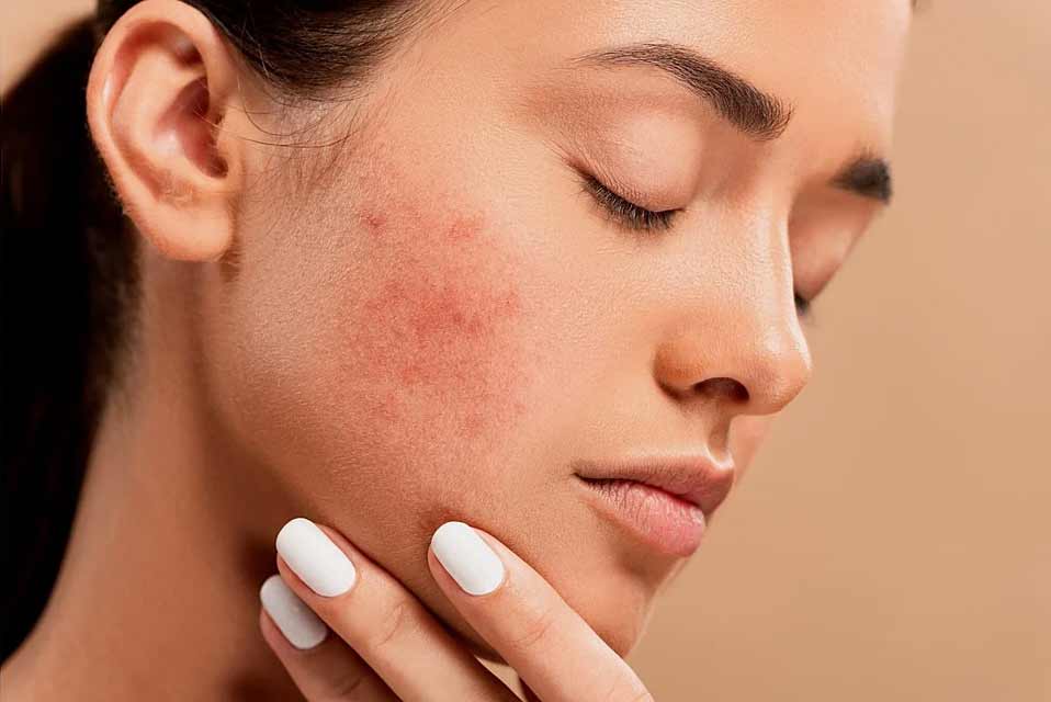 Acne & Blemishes