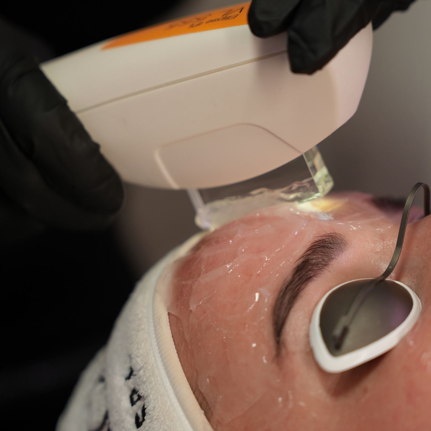 Candela Nordlys IPL Photofacial