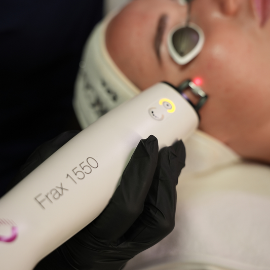 Candela Frax Laser Skin Resurfacing Treatment