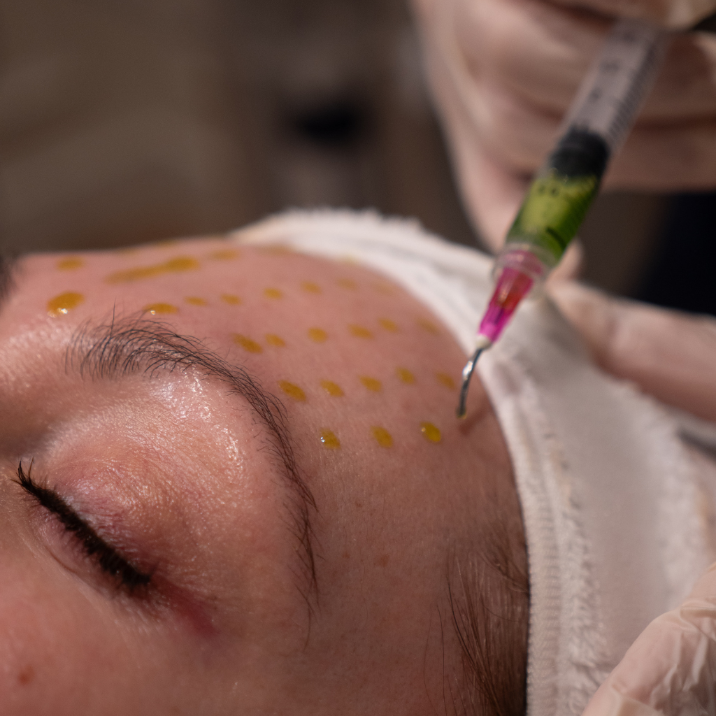 BioRePeel Chemical Peels