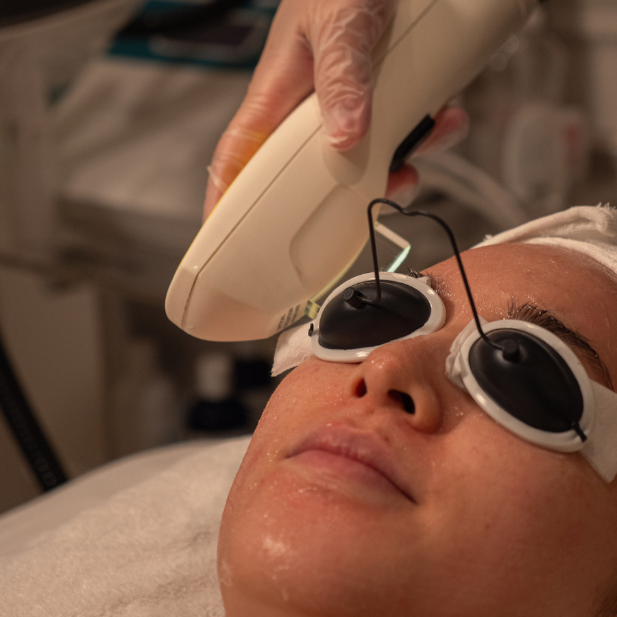 IPL Photofacial
