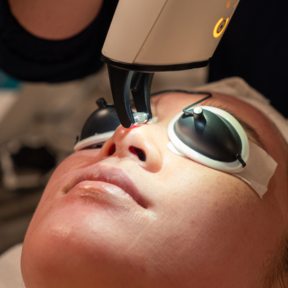 Candela Frax Laser Skin Resurfacing Treatment