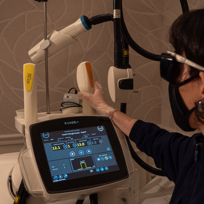 Candela Nordlys IPL Photofacial