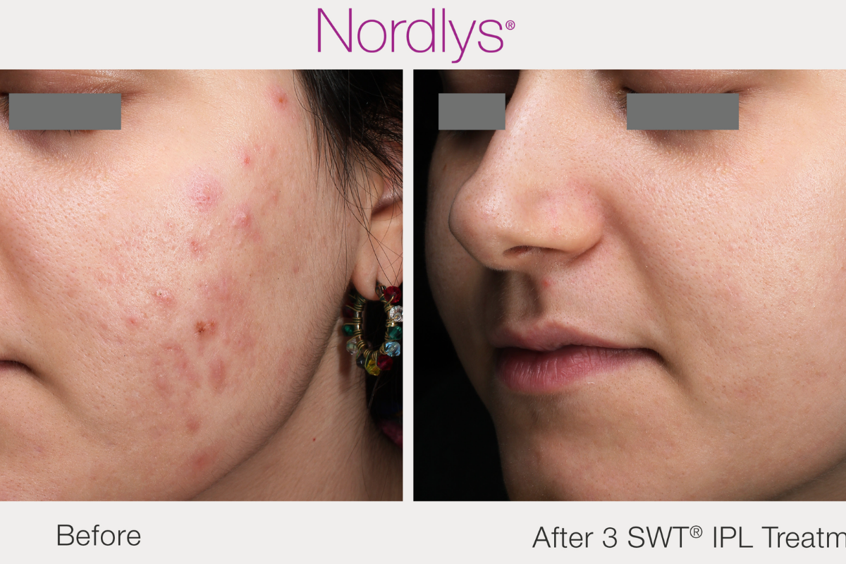 A before and after images showing the results of the clients after finishing 3 sessions of Candela Nordlys IPL treatments