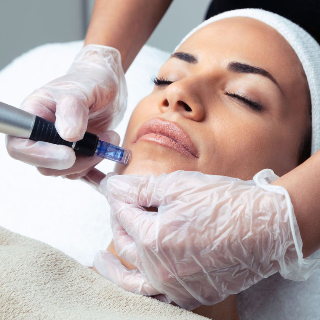 Candela Exceed Microneedling