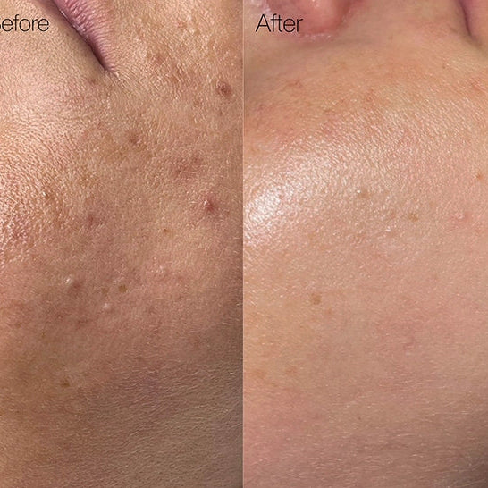 Before and after comparison of skin texture on a person's face after BioRePeel treatment.
