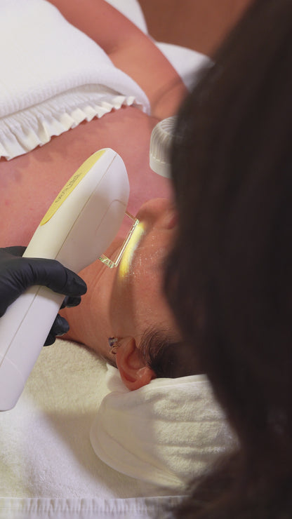 Candela Nordlys IPL Photofacial