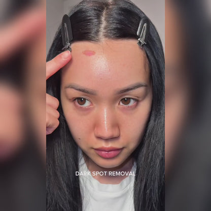 Candela Nordlys IPL Photofacial